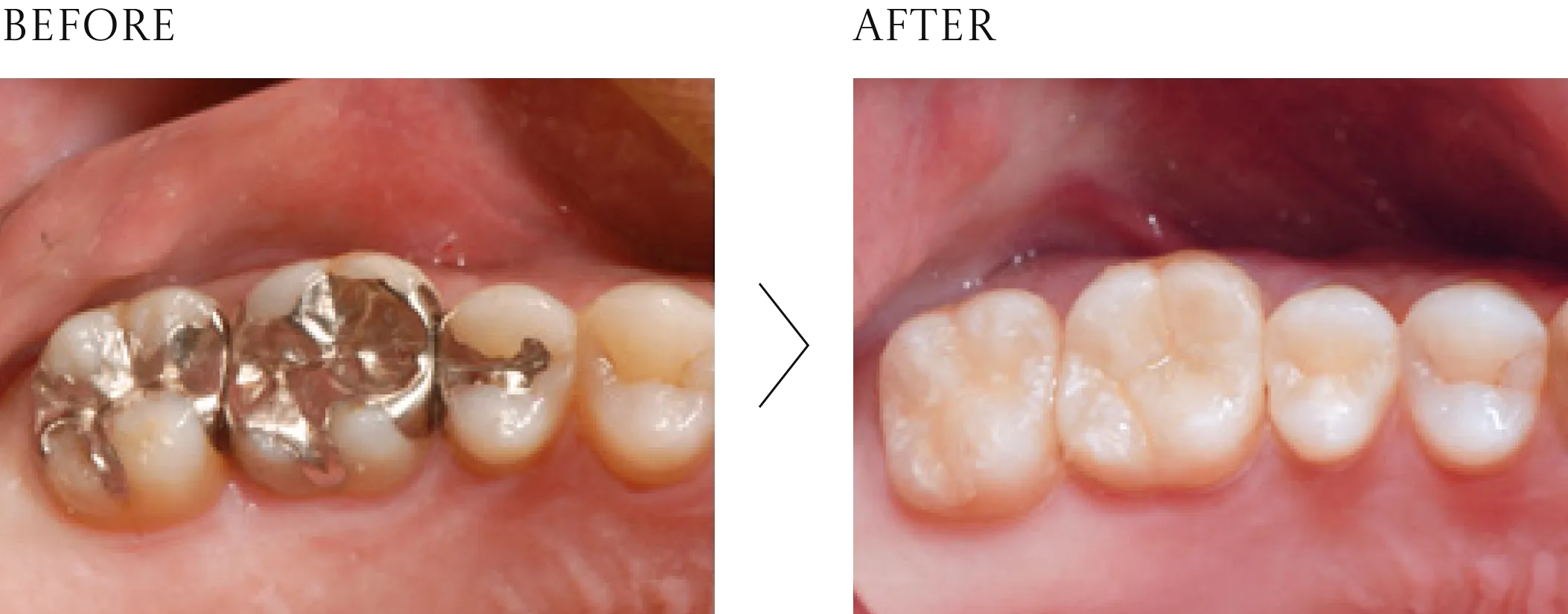 白い詰め物の症例